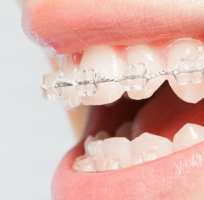 What is the Procedure of Orthodontic Treatment?