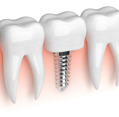 dental implants in oshawa harmony dental