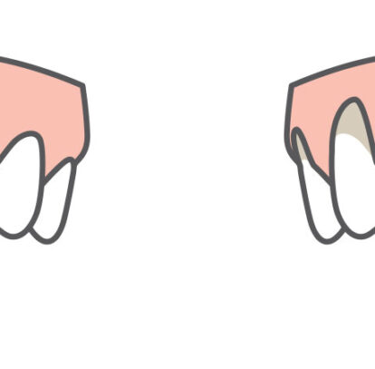 gum recession oshawa dentist