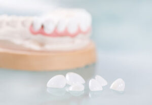 dental veneers oshawa dentist cosmetic dentistry
