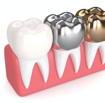 porcelain dental crown oshawa dentist