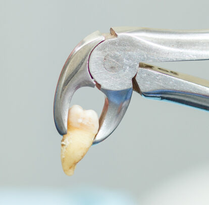 Guidelines for Recovery After Wisdom Teeth Extraction