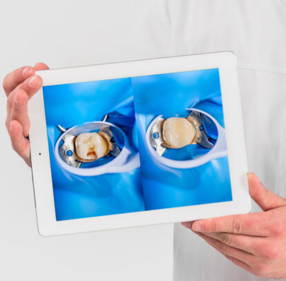 Smile Confidently with Natural-Looking Tooth-Colored Fillings